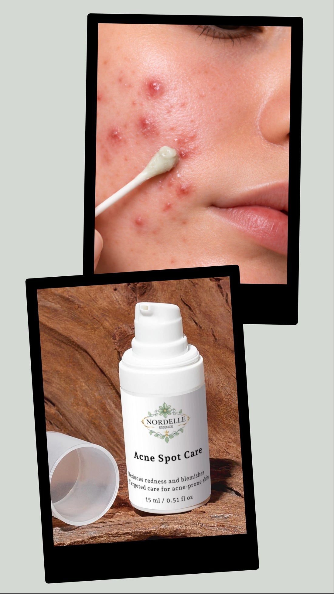 Acne-Prone Skin: Causes, Triggers & Skincare Routine